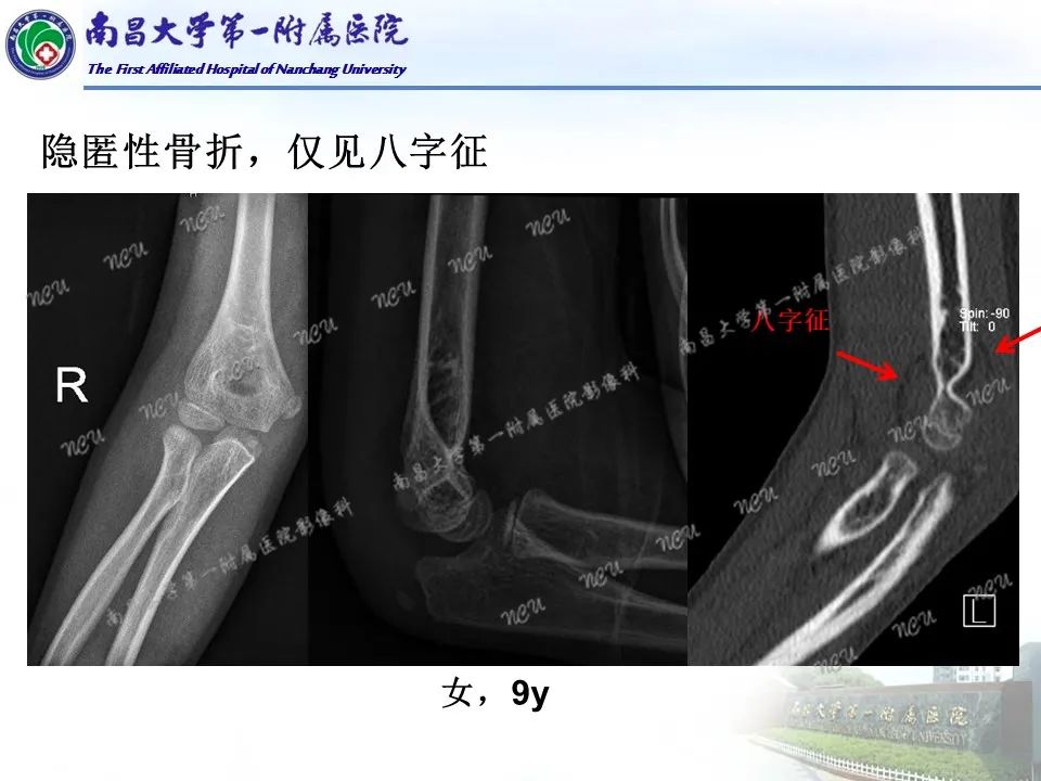 影像PPT - 【PPT】儿童肘关节骨折X线诊断-31