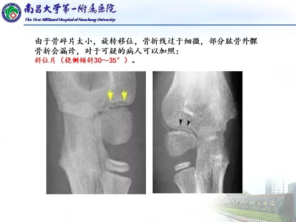 影像PPT - 【PPT】儿童肘关节骨折X线诊断-33