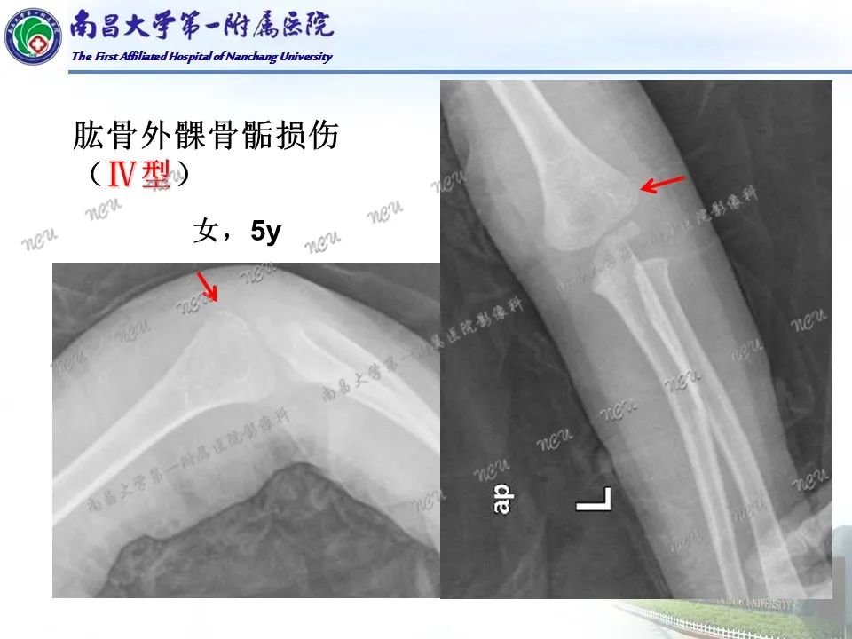 影像PPT - 【PPT】儿童肘关节骨折X线诊断-34