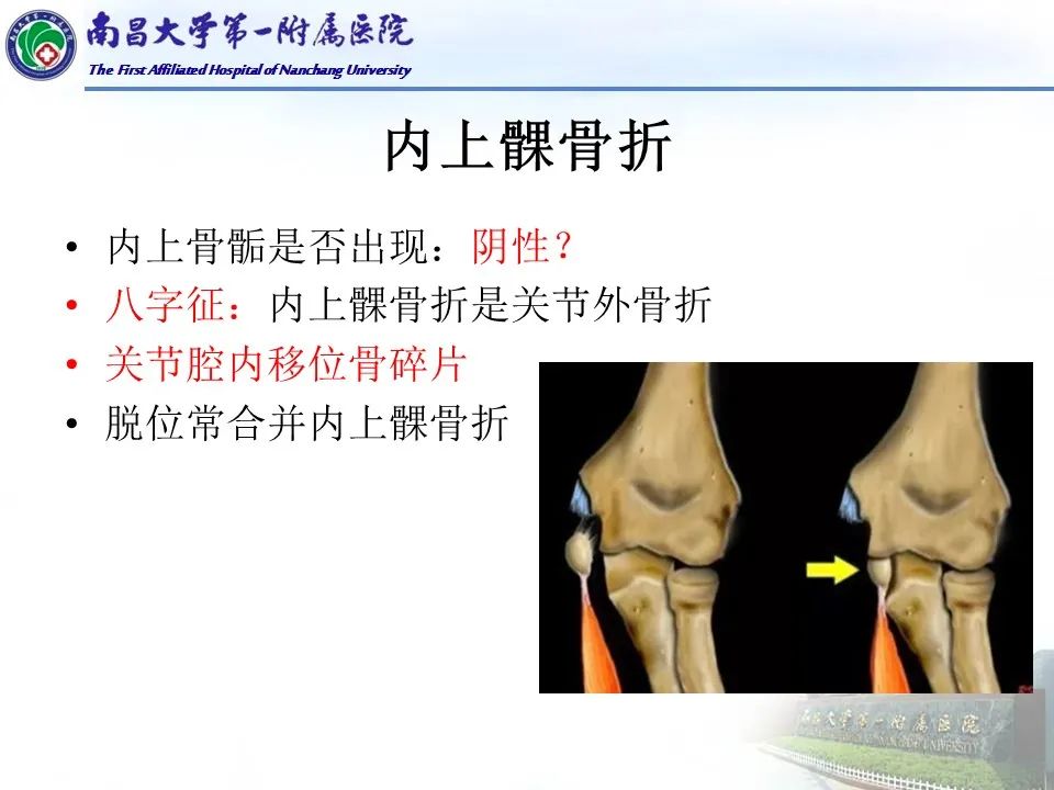 影像PPT - 【PPT】儿童肘关节骨折X线诊断-36