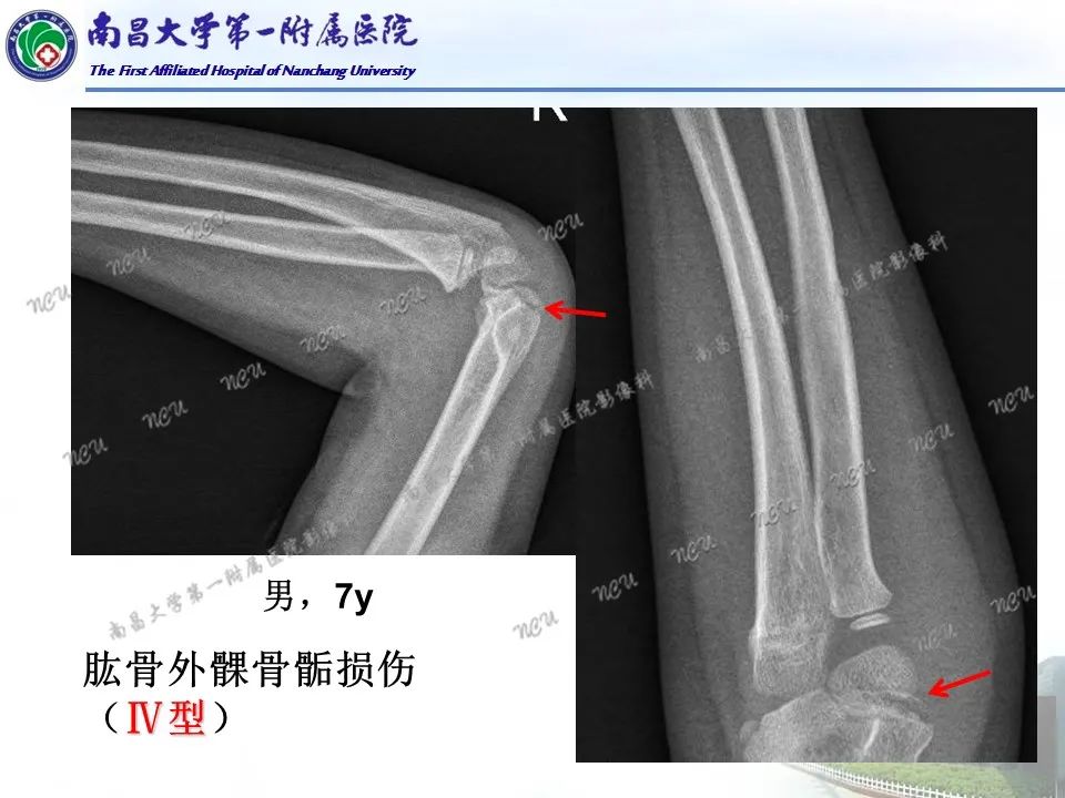影像PPT - 【PPT】儿童肘关节骨折X线诊断-35