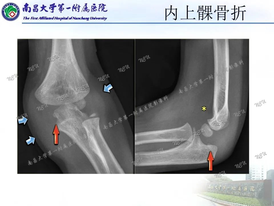 影像PPT - 【PPT】儿童肘关节骨折X线诊断-37
