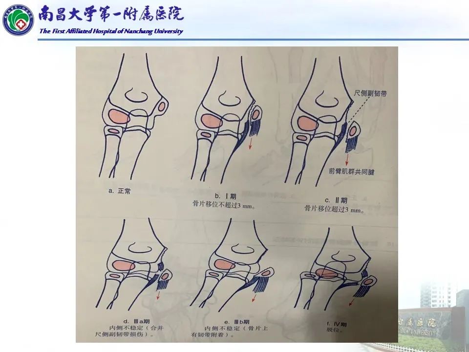 影像PPT - 【PPT】儿童肘关节骨折X线诊断-38