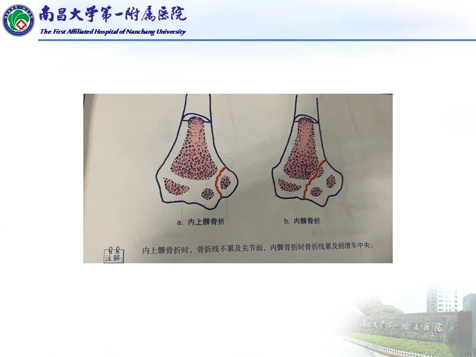 影像PPT - 【PPT】儿童肘关节骨折X线诊断-39