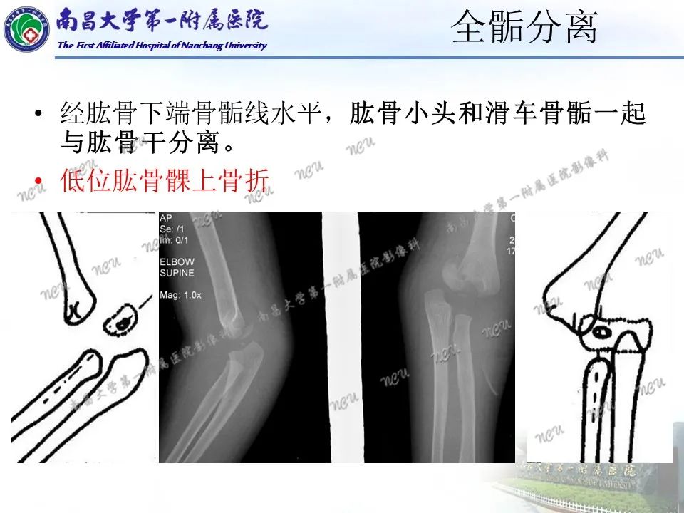 影像PPT - 【PPT】儿童肘关节骨折X线诊断-40