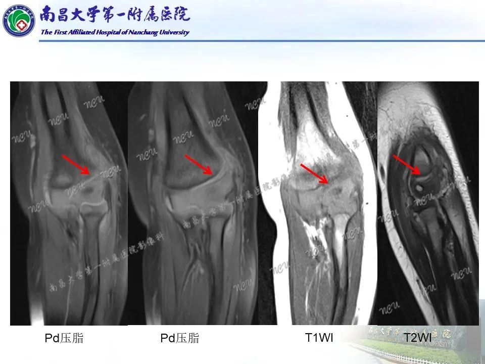 影像PPT - 【PPT】儿童肘关节骨折X线诊断-42