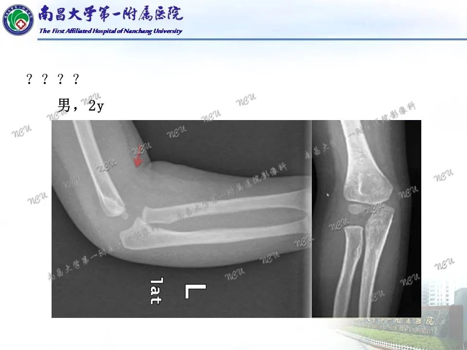 影像PPT - 【PPT】儿童肘关节骨折X线诊断-41