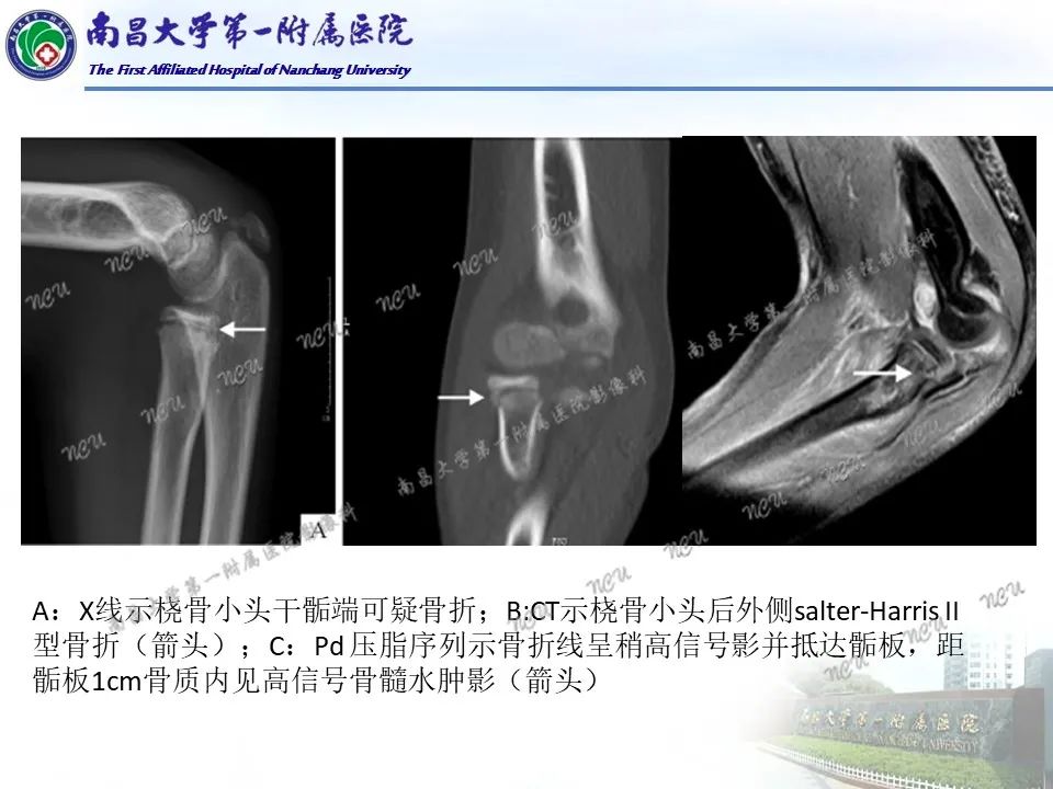 影像PPT - 【PPT】儿童肘关节骨折X线诊断-43