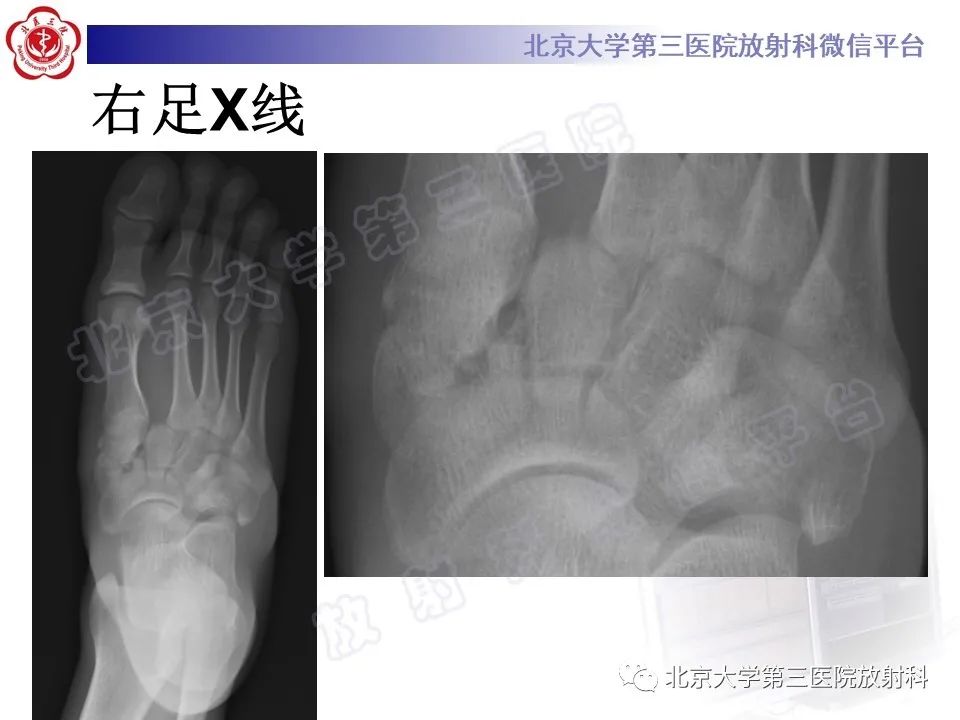 影像PPT - 【PPT】Lisfranc损伤-3