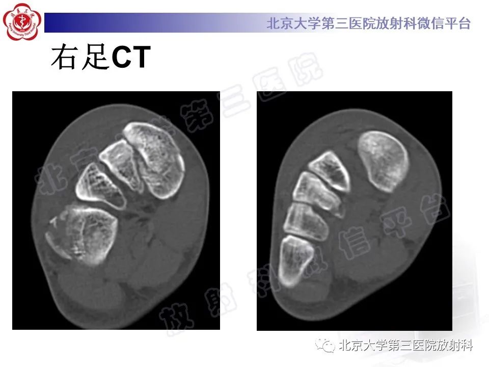 影像PPT - 【PPT】Lisfranc损伤-5