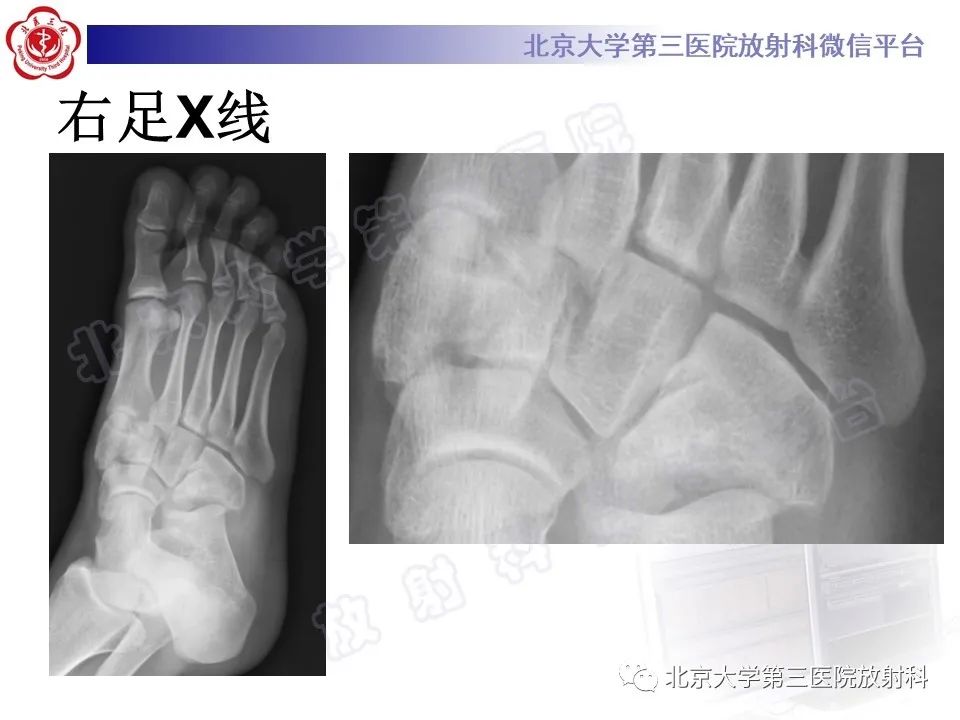 影像PPT - 【PPT】Lisfranc损伤-4