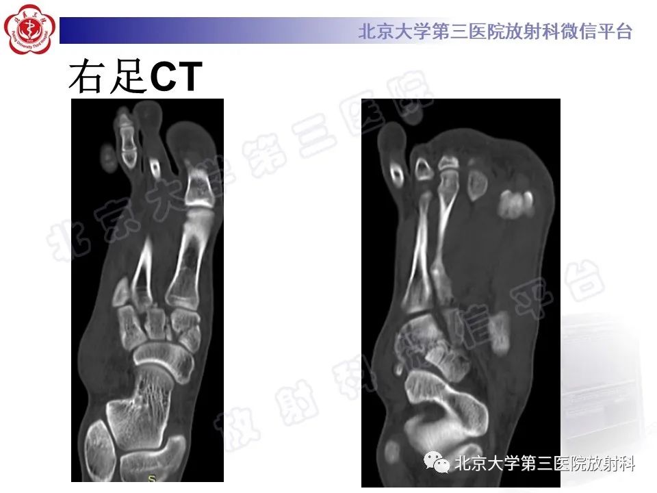 影像PPT - 【PPT】Lisfranc损伤-6
