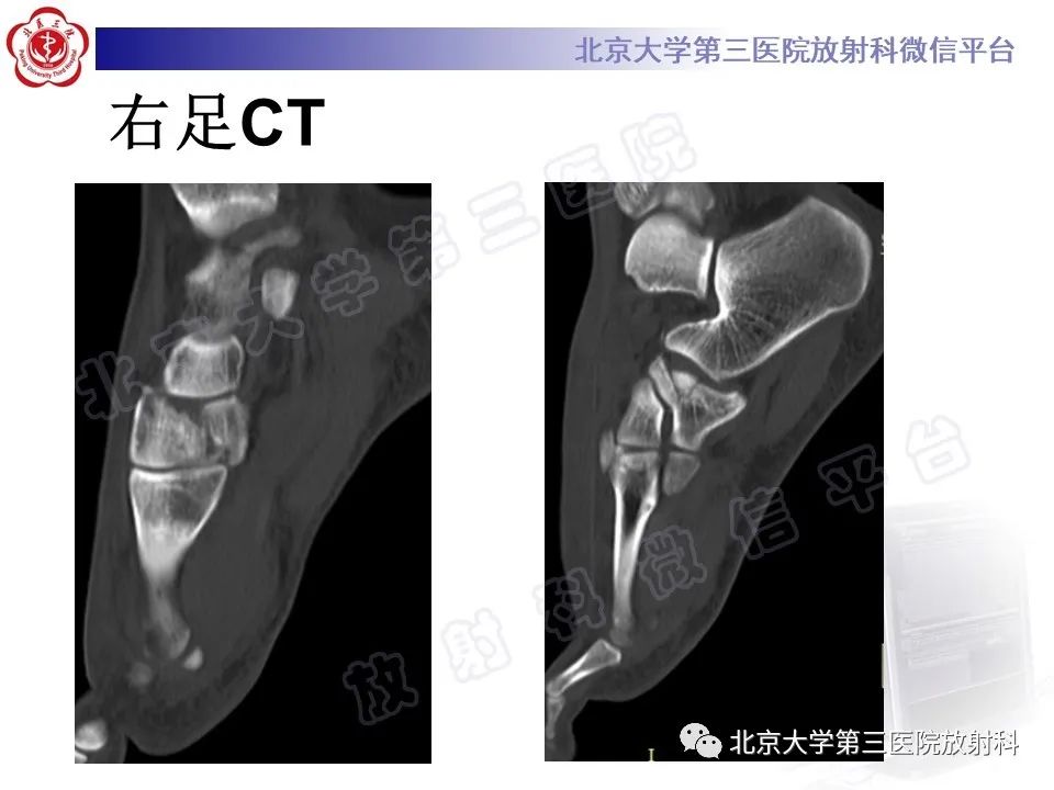 影像PPT - 【PPT】Lisfranc损伤-7
