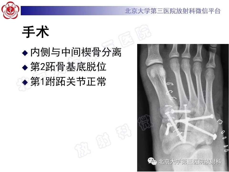 影像PPT - 【PPT】Lisfranc损伤-11