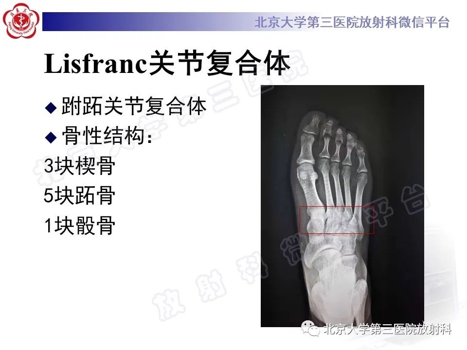 影像PPT - 【PPT】Lisfranc损伤-13