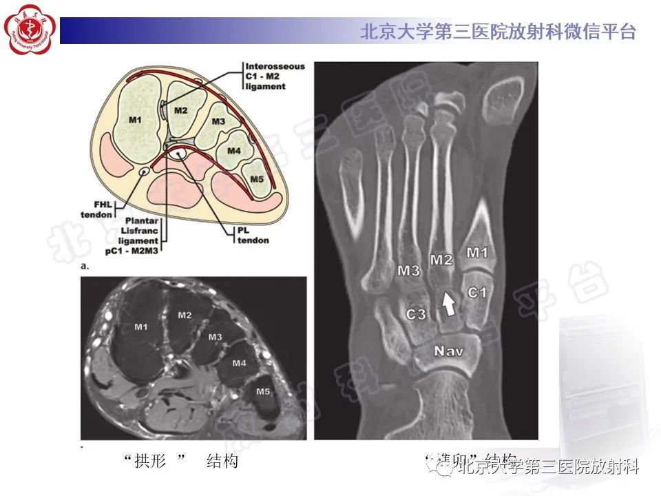 影像PPT - 【PPT】Lisfranc损伤-14