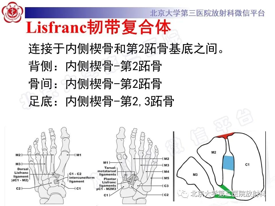影像PPT - 【PPT】Lisfranc损伤-17