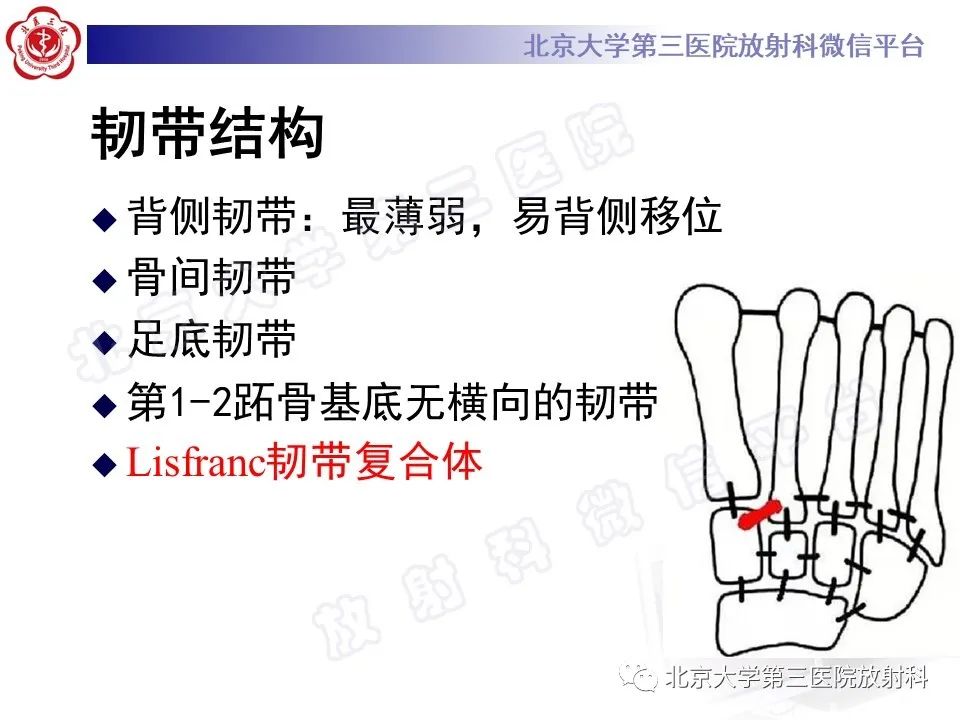 影像PPT - 【PPT】Lisfranc损伤-16