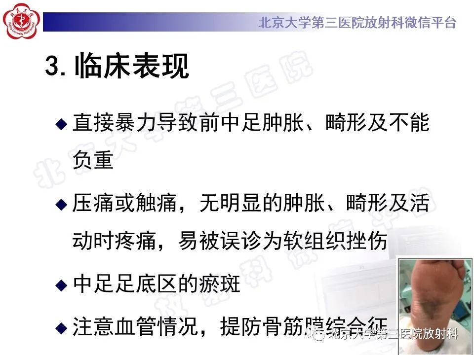 影像PPT - 【PPT】Lisfranc损伤-22