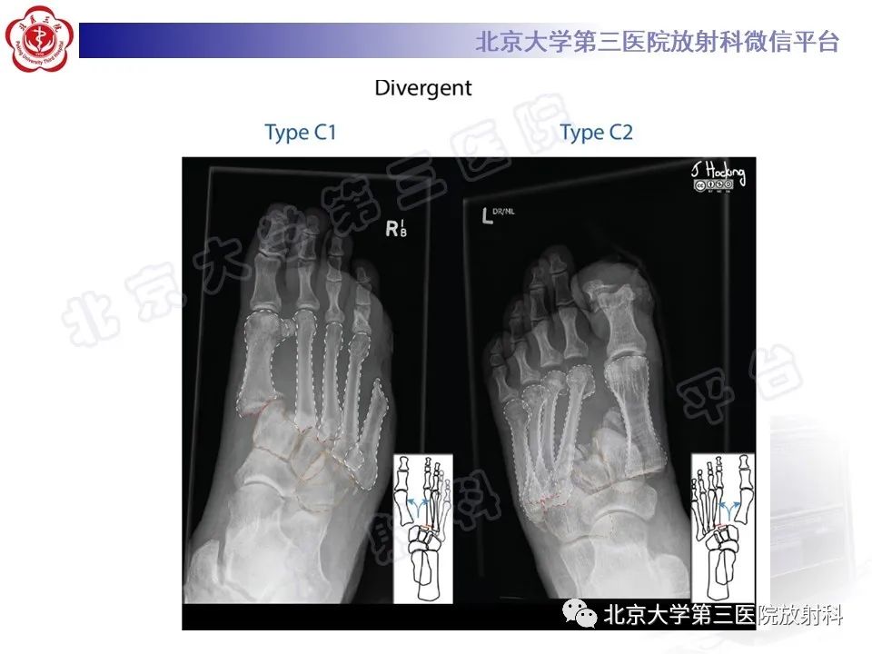 影像PPT - 【PPT】Lisfranc损伤-26