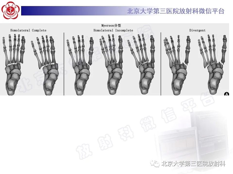 影像PPT - 【PPT】Lisfranc损伤-27