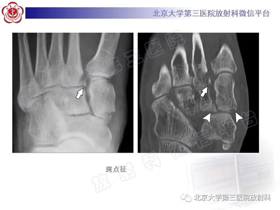 影像PPT - 【PPT】Lisfranc损伤-33