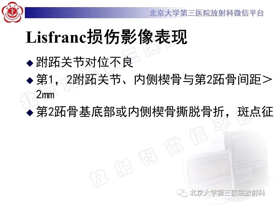 影像PPT - 【PPT】Lisfranc损伤-32
