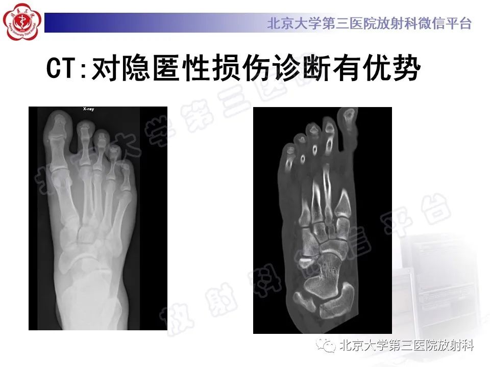 影像PPT - 【PPT】Lisfranc损伤-36