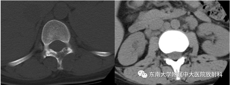 影像PPT - 【PPT】椎管内硬膜外肿瘤-1