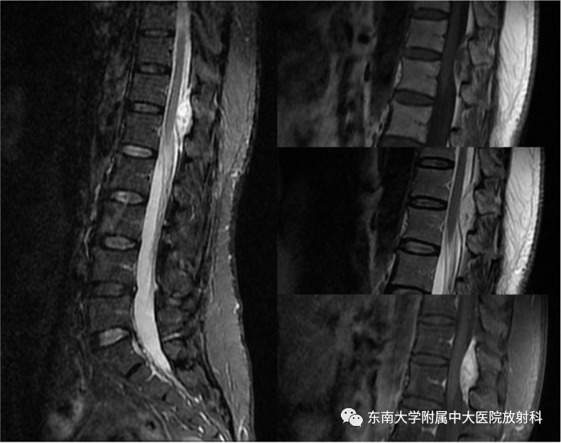 影像PPT - 【PPT】椎管内硬膜外肿瘤-4