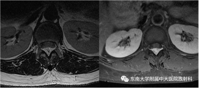 影像PPT - 【PPT】椎管内硬膜外肿瘤-5