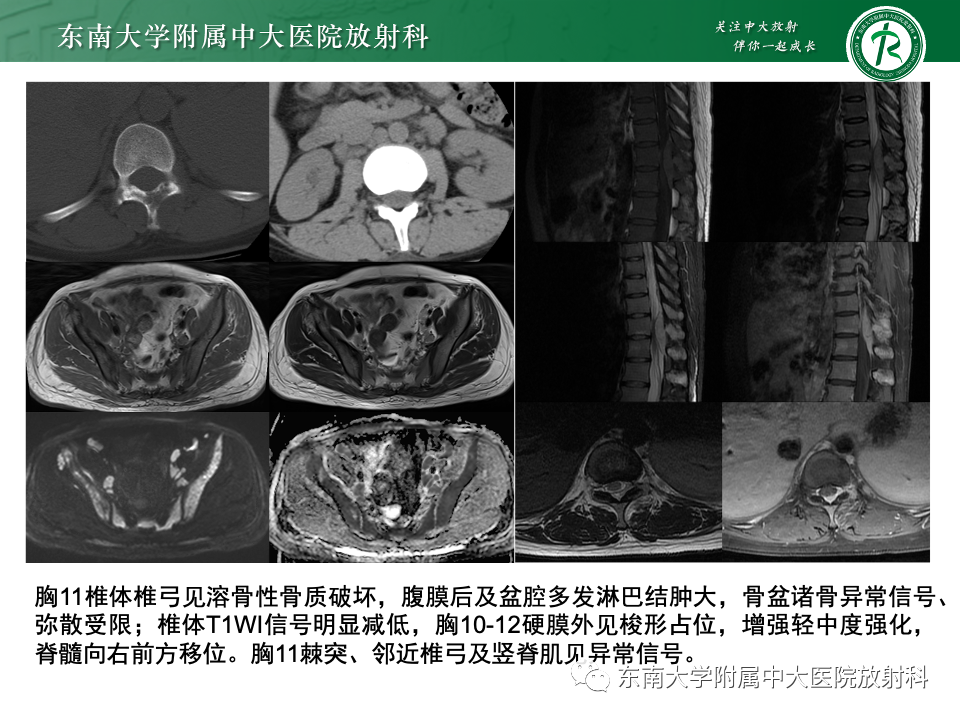 影像PPT - 【PPT】椎管内硬膜外肿瘤-7