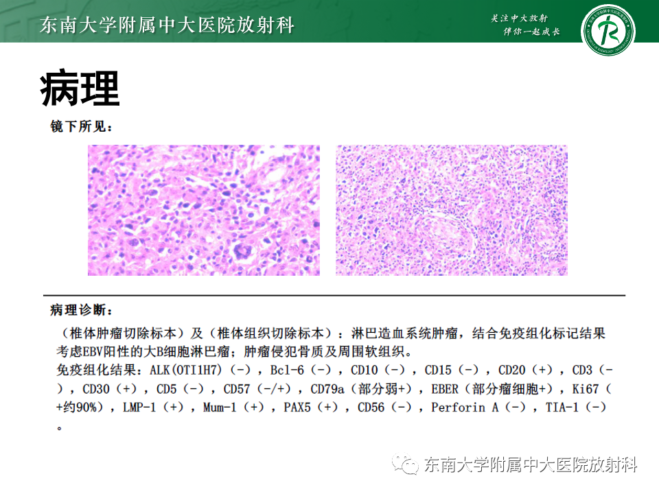 影像PPT - 【PPT】椎管内硬膜外肿瘤-8