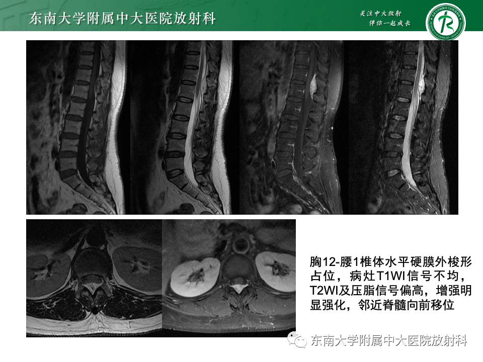影像PPT - 【PPT】椎管内硬膜外肿瘤-10