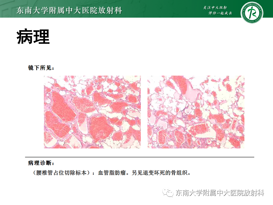 影像PPT - 【PPT】椎管内硬膜外肿瘤-11