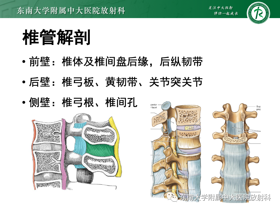 影像PPT - 【PPT】椎管内硬膜外肿瘤-13