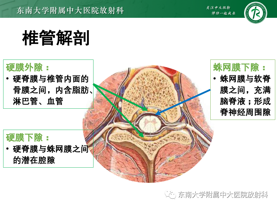 影像PPT - 【PPT】椎管内硬膜外肿瘤-14