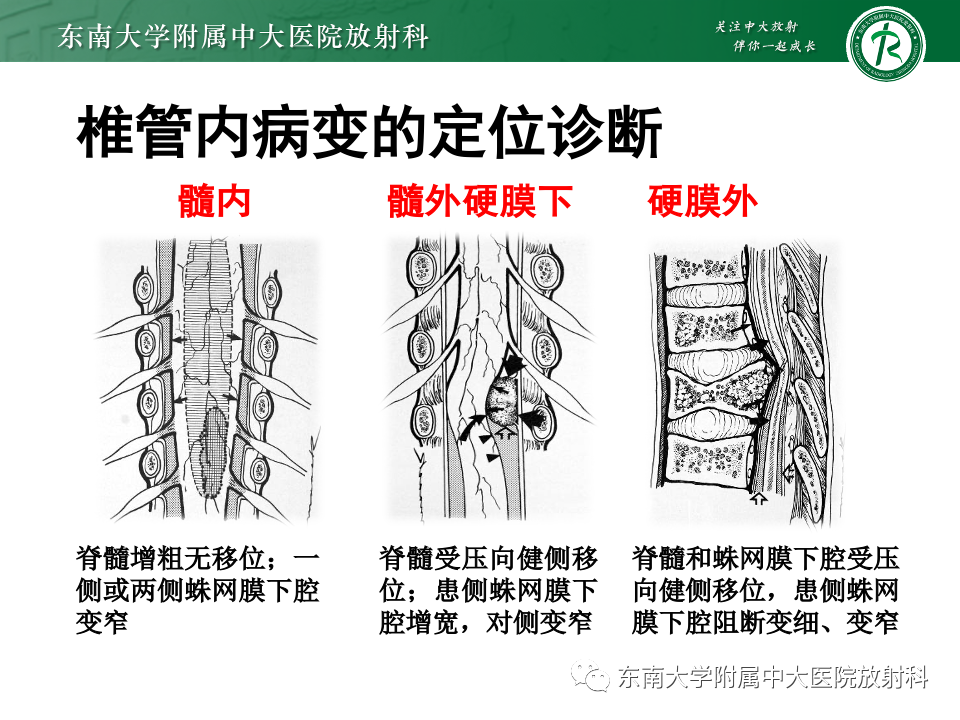 影像PPT - 【PPT】椎管内硬膜外肿瘤-15