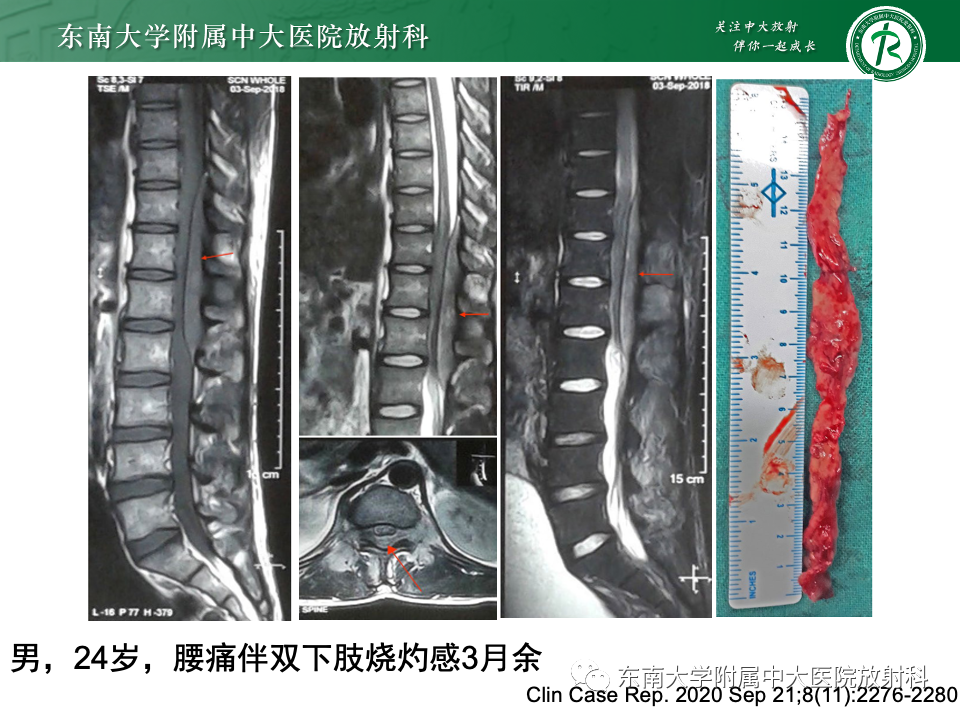 影像PPT - 【PPT】椎管内硬膜外肿瘤-21