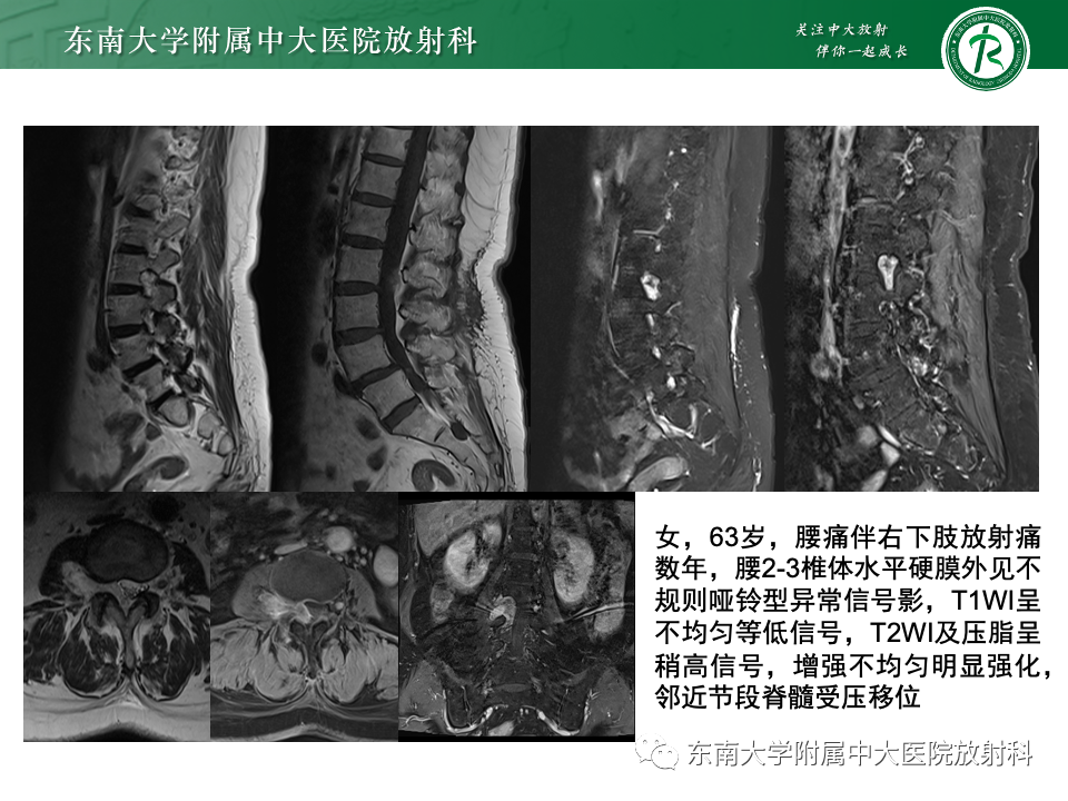 影像PPT - 【PPT】椎管内硬膜外肿瘤-28