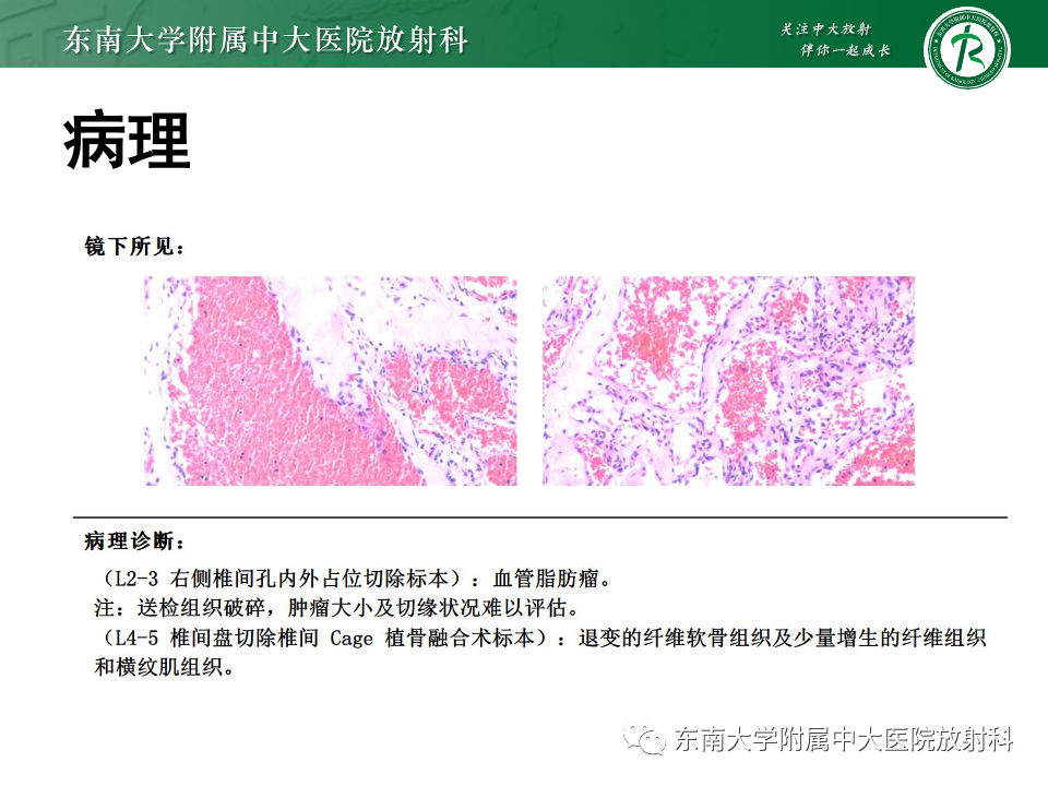 影像PPT - 【PPT】椎管内硬膜外肿瘤-29