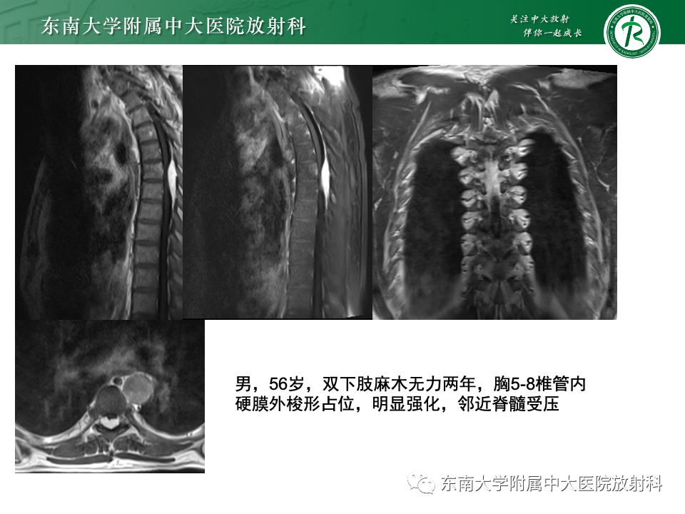 影像PPT - 【PPT】椎管内硬膜外肿瘤-30