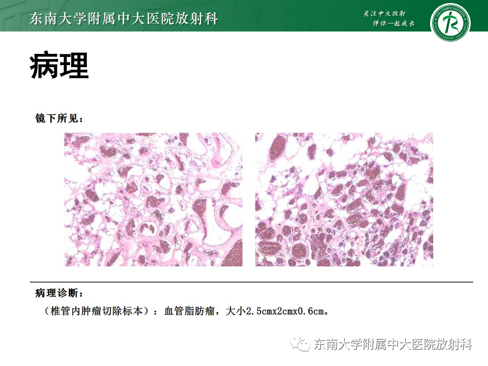 影像PPT - 【PPT】椎管内硬膜外肿瘤-31