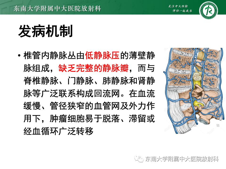 影像PPT - 【PPT】椎管内硬膜外肿瘤-33