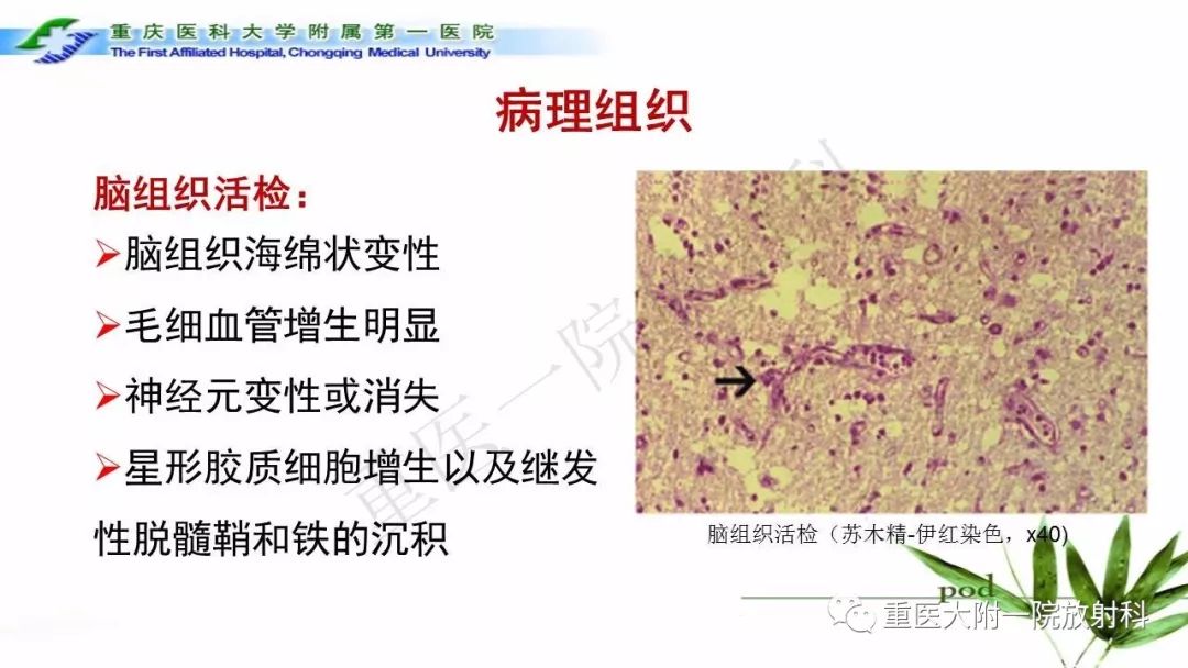影像PPT - 【PPT】MELAS型线粒体脑肌病影像诊断及鉴别诊断-7