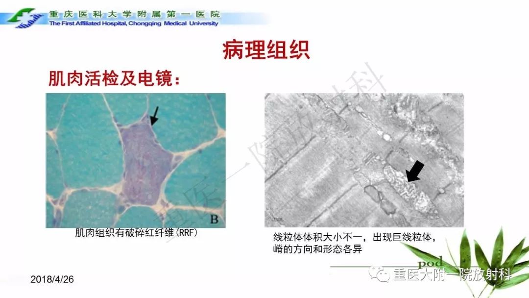 影像PPT - 【PPT】MELAS型线粒体脑肌病影像诊断及鉴别诊断-8