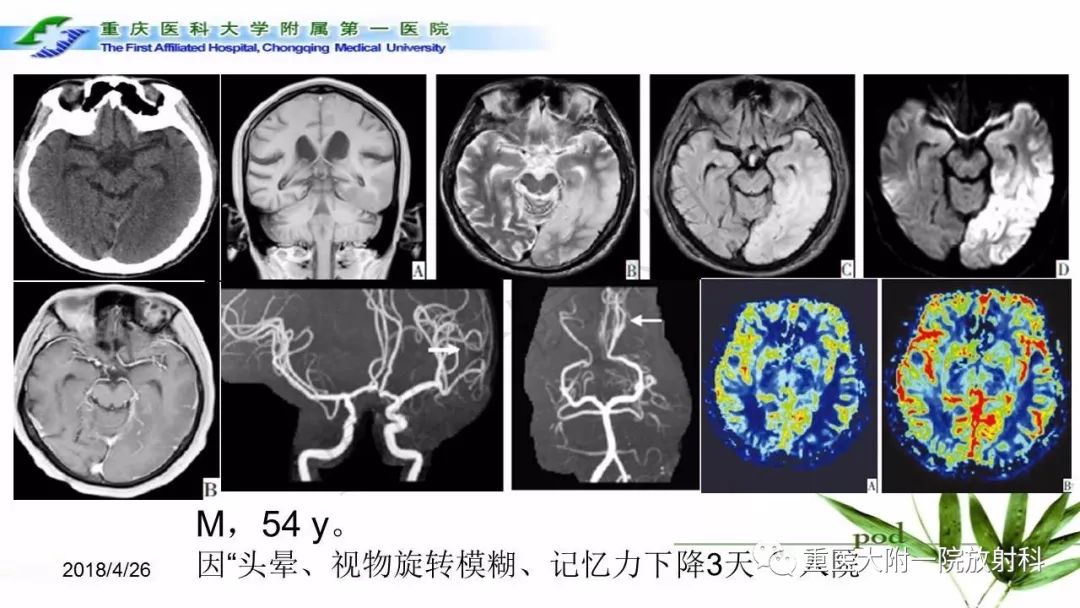影像PPT - 【PPT】MELAS型线粒体脑肌病影像诊断及鉴别诊断-12