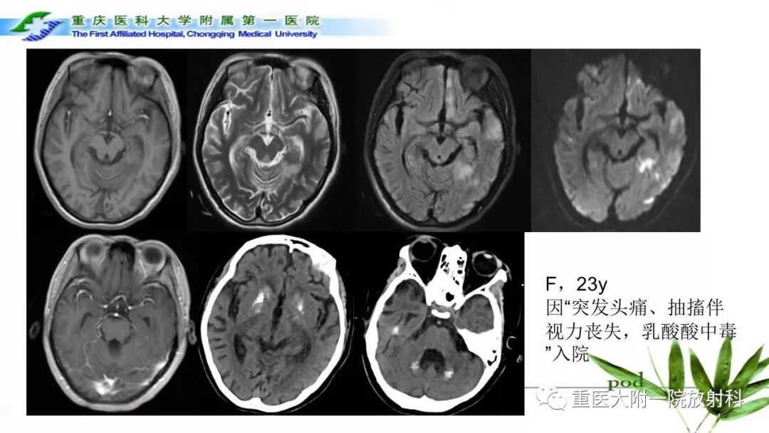 影像PPT - 【PPT】MELAS型线粒体脑肌病影像诊断及鉴别诊断-14