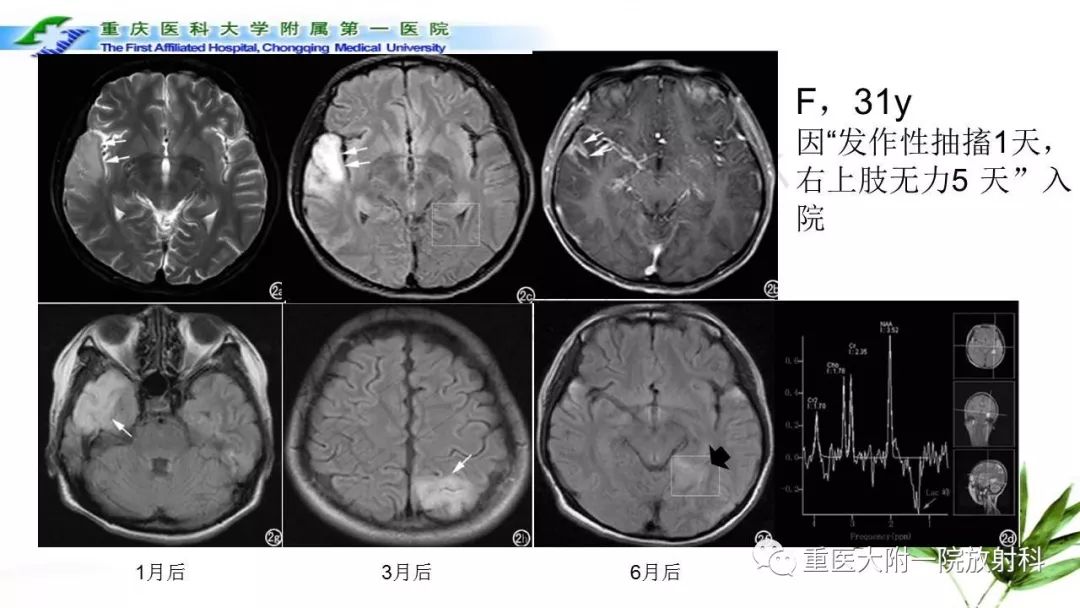 影像PPT - 【PPT】MELAS型线粒体脑肌病影像诊断及鉴别诊断-13