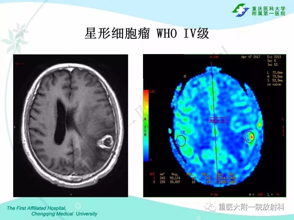 影像PPT - 【PPT】MELAS型线粒体脑肌病影像诊断及鉴别诊断-20